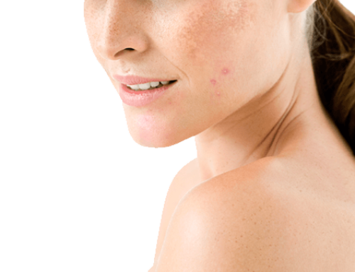 Melasma y verano, ¿enemigos íntimos?